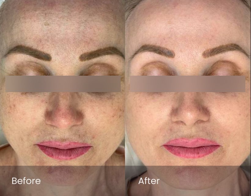 PicoSure Pro Rejuvenation