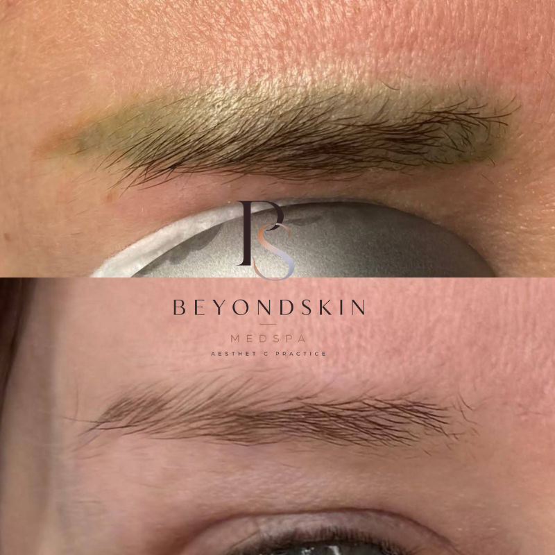 Eyebrow tattoo removal before and after, 7 sessions