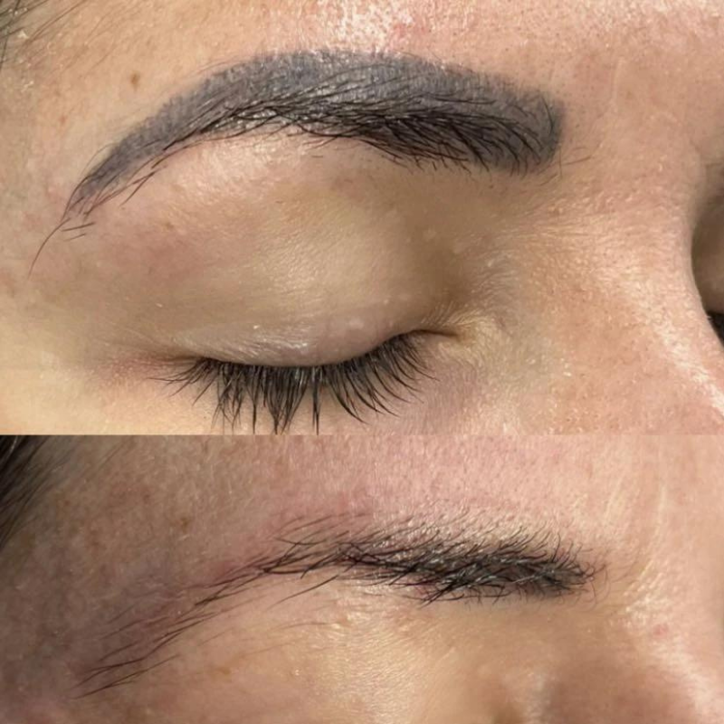 Eyebrow tattoo removal before and after