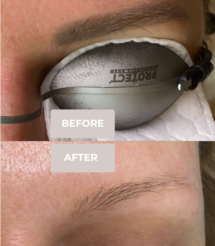 Eyebrow tattoo removal before and after
