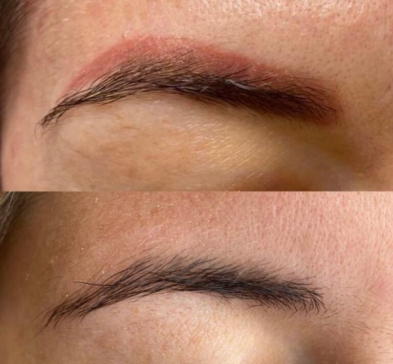 Why Do Some Eyebrows Turn Red After Laser PMU Removal?